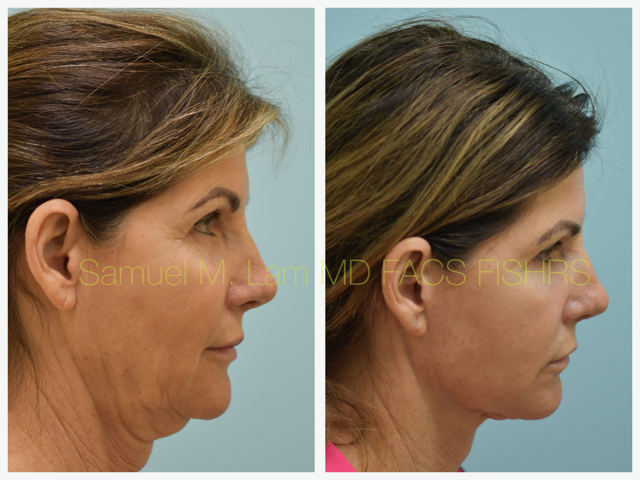 Fat Grafting and Facelift Before and After Photo by Dr. Lam in Plano, TX