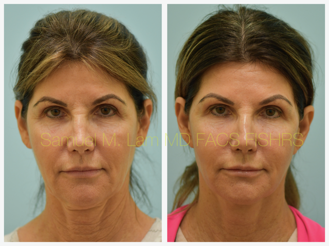 Fat Grafting and Facelift Before and After Photo by Dr. Lam in Plano, TX