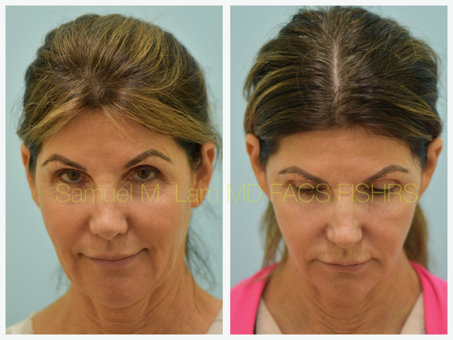 Fat Grafting and Facelift Before and After Photo by Dr. Lam in Plano, TX