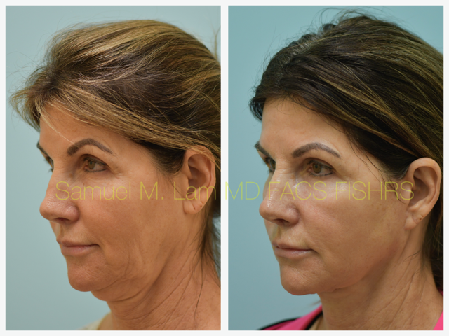 Fat Grafting and Facelift Before and After Photo by Dr. Lam in Plano, TX