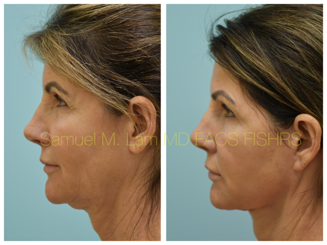 Fat Grafting and Facelift Before and After Photo by Dr. Lam in Plano, TX