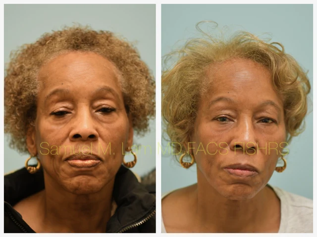 Blepharoplasty and Fat Grafting Before and After Photo by Dr. Lam in Plano TX