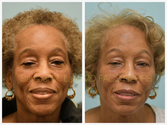 Blepharoplasty and Fat Grafting Before and After Photo by Dr. Lam in Plano TX