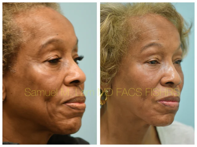 Blepharoplasty and Fat Grafting Before and After Photo by Dr. Lam in Plano TX