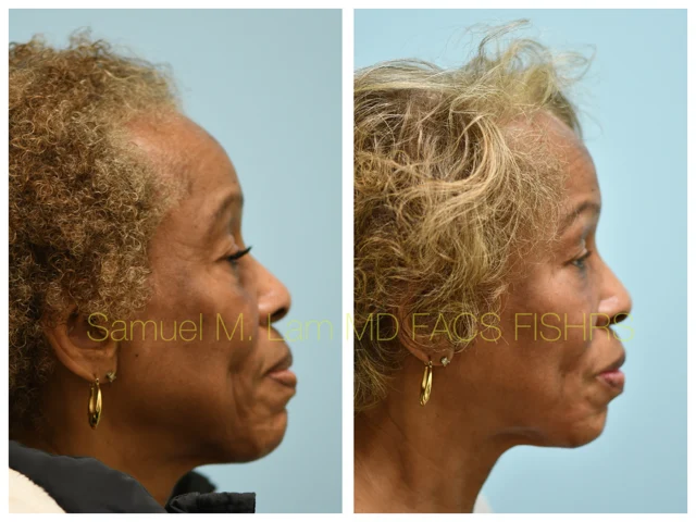 Blepharoplasty and Fat Grafting Before and After Photo by Dr. Lam in Plano TX
