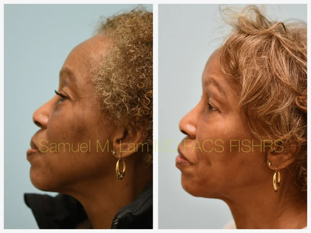 Blepharoplasty and Fat Grafting Before and After Photo by Dr. Lam in Plano TX