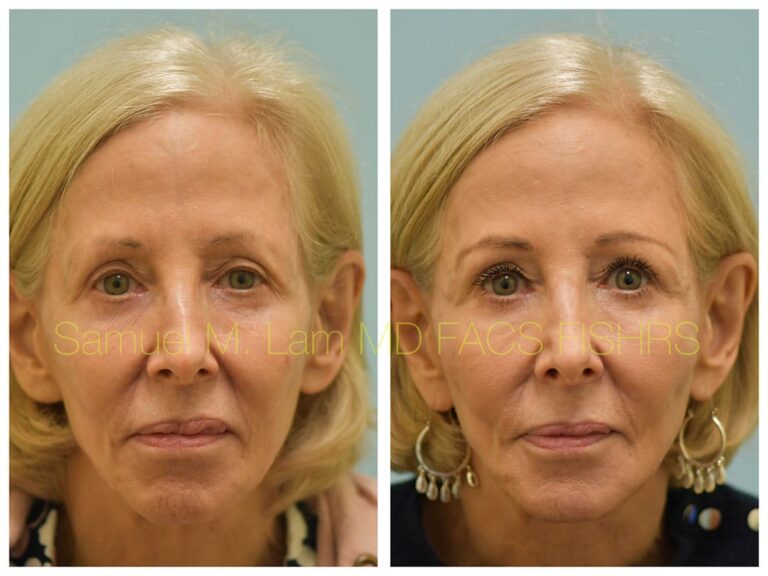 Eyelid Before and After Photo by Dr. Lam in Plano TX