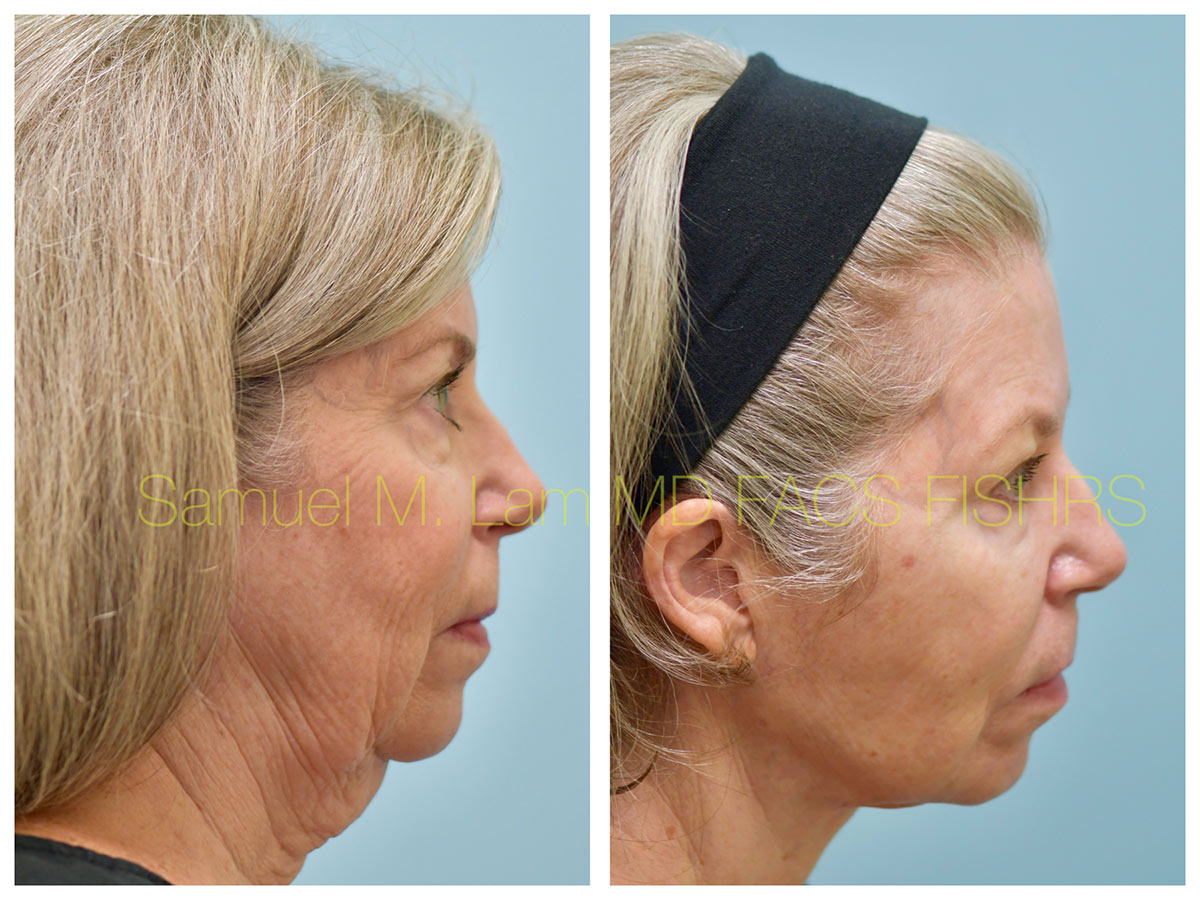 Facelift Before and After Photo by Dr. Lam in Plano, TX