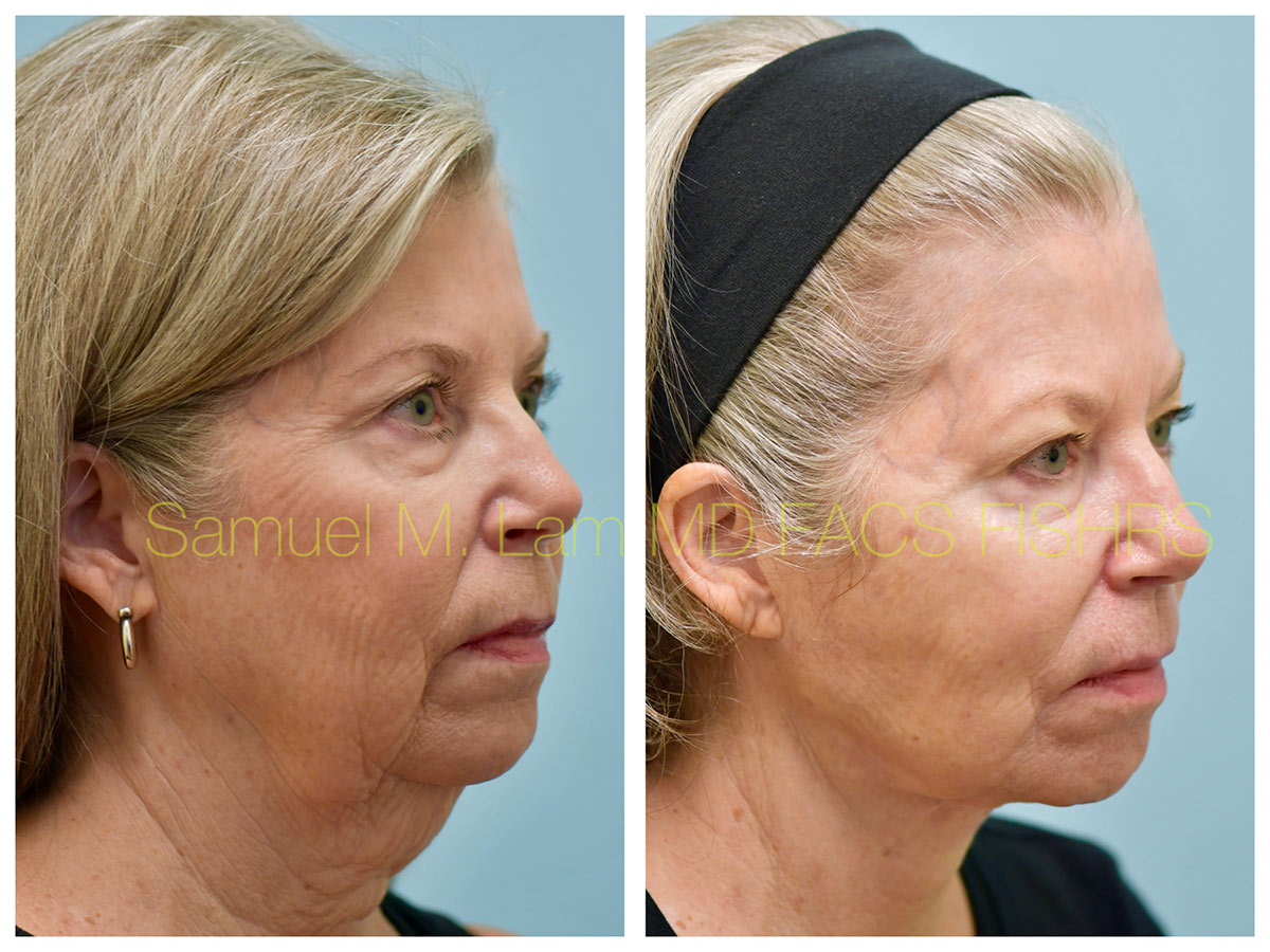 Facelift Before and After Photo by Dr. Lam in Plano, TX