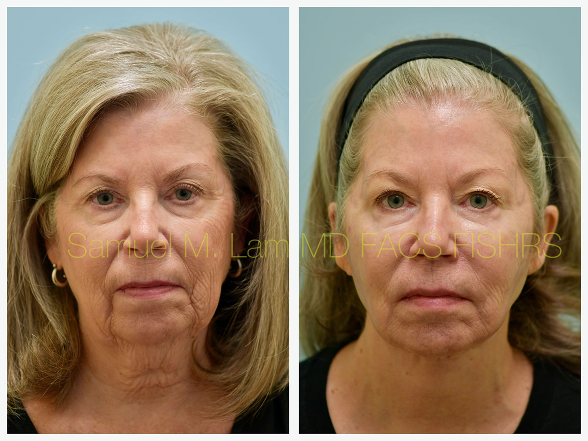 Facelift Before and After Photo by Dr. Lam in Plano, TX