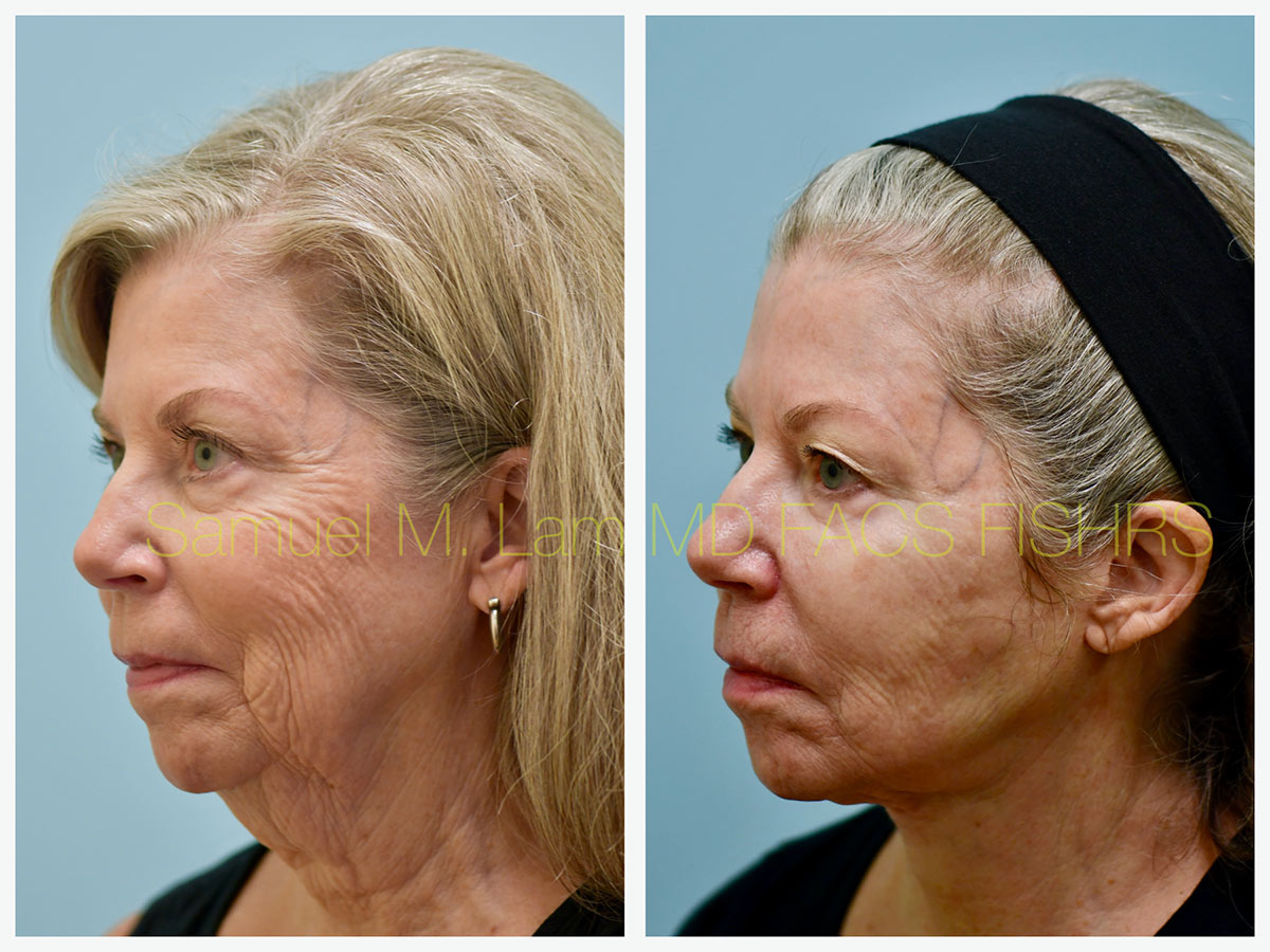 Facelift Before and After Photo by Dr. Lam in Plano, TX