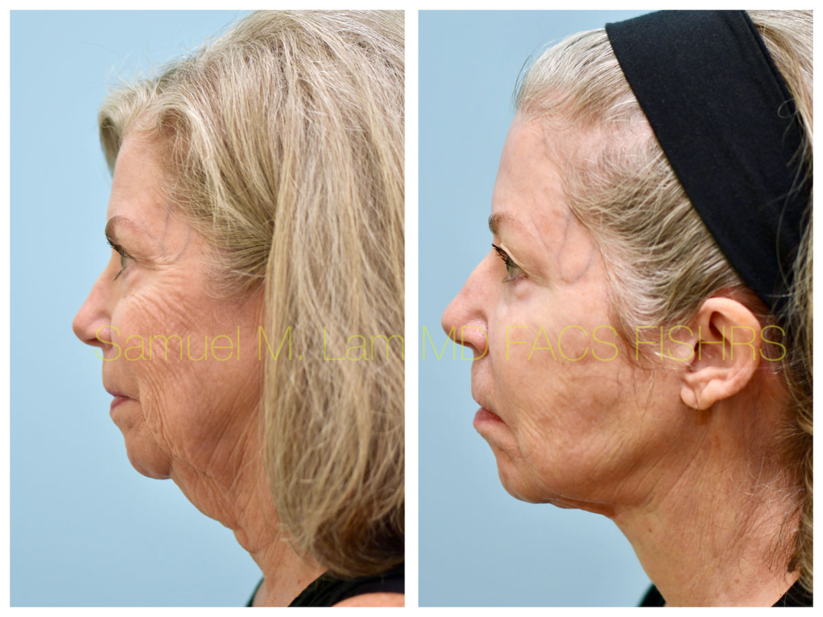 Facelift Before and After Photo by Dr. Lam in Plano, TX