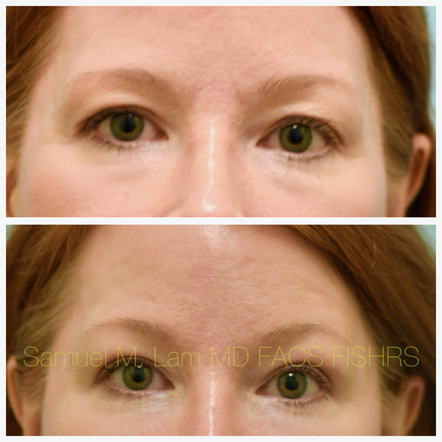Fat Grafting and Blepharoplasty Before and After Photo by Dr. Lam in Plano, TX