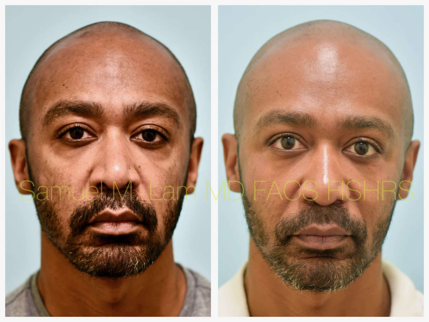 Fat Grafting and Blepharoplasty Before and After Photo by Dr. Lam in Plano TX