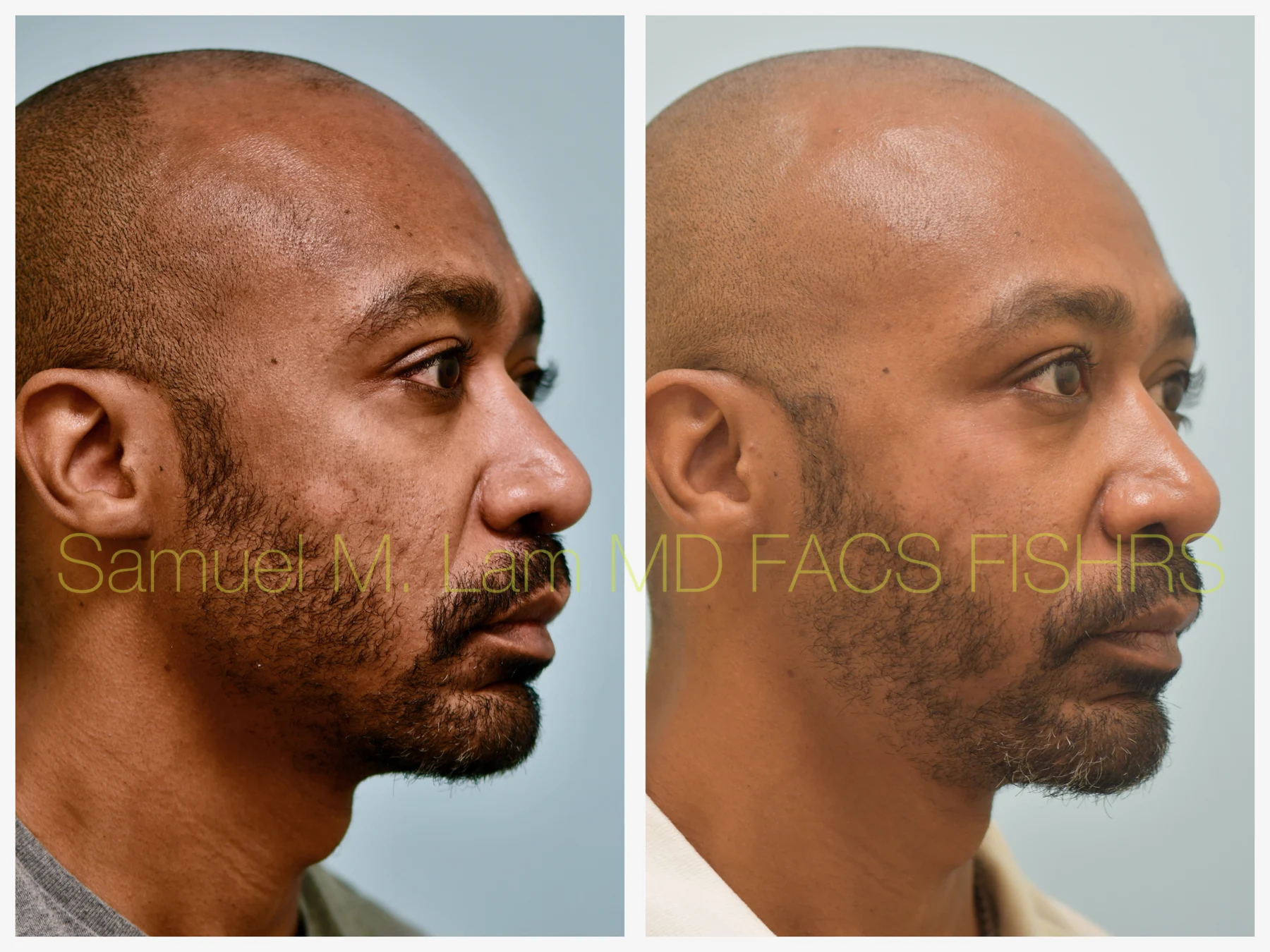 Fat Grafting and Blepharoplasty Before and After Photo by Dr. Lam in Plano TX