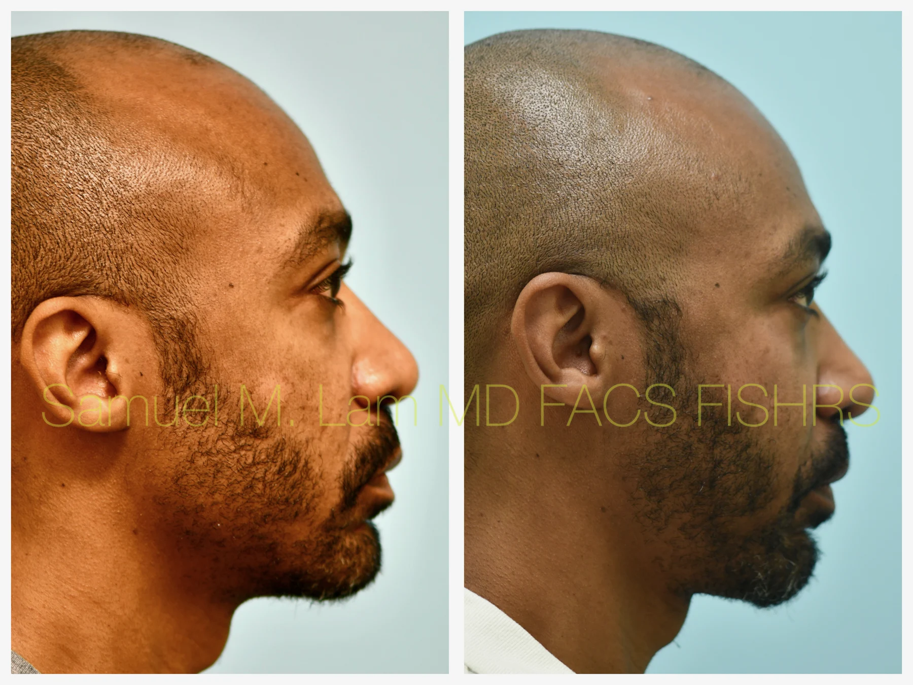 Fat Grafting and Blepharoplasty Before and After Photo by Dr. Lam in Plano TX