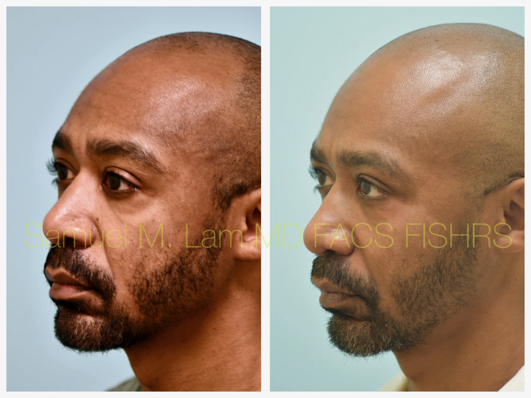 Fat Grafting and Blepharoplasty Before and After Photo by Dr. Lam in Plano TX
