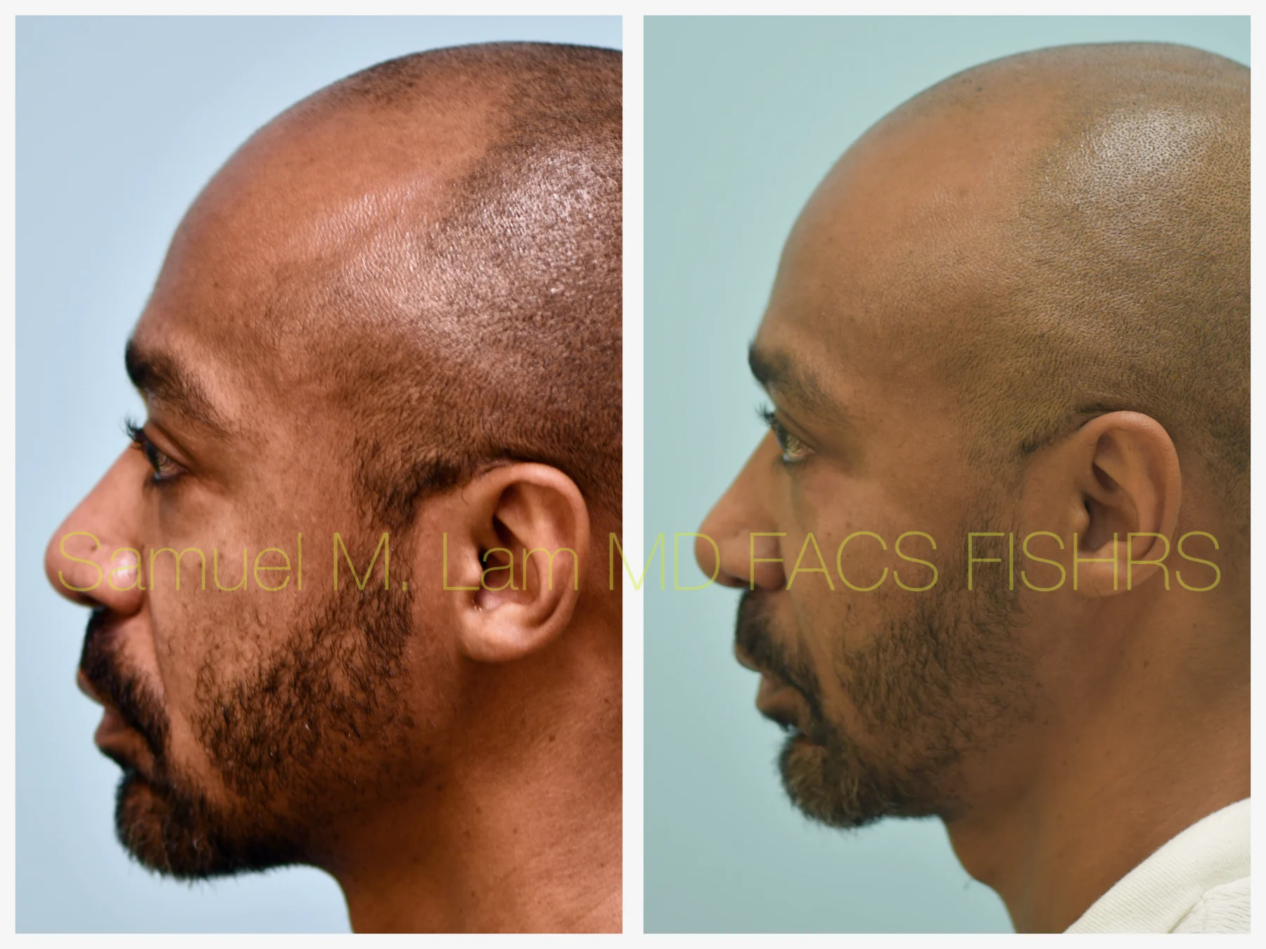 Fat Grafting and Blepharoplasty Before and After Photo by Dr. Lam in Plano TX