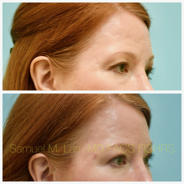 Fat Grafting and Blepharoplasty Before and After Photo by Dr. Lam in Plano, TX