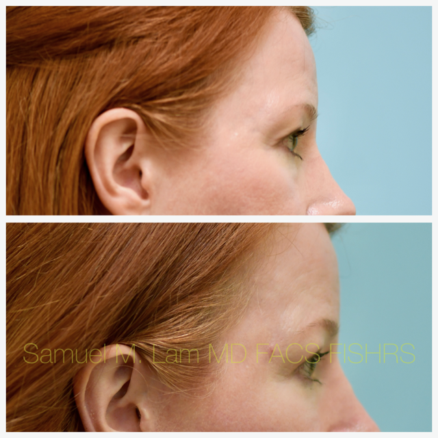 Fat Grafting and Blepharoplasty Before and After Photo by Dr. Lam in Plano, TX