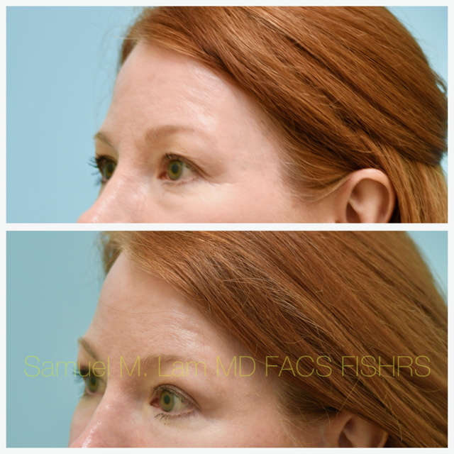 Fat Grafting and Blepharoplasty Before and After Photo by Dr. Lam in Plano, TX