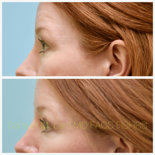Fat Grafting and Blepharoplasty Before and After Photo by Dr. Lam in Plano, TX
