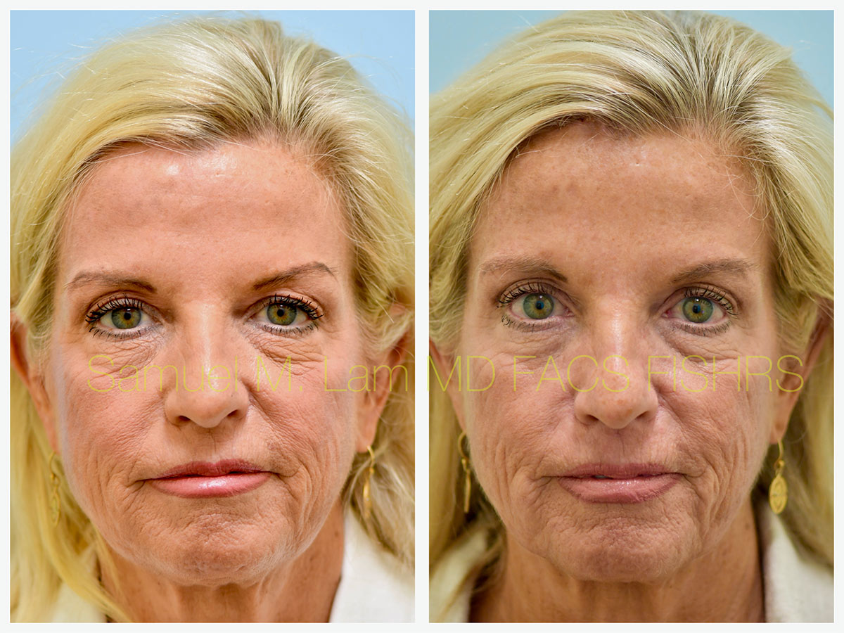 Osteoma Removal Before and After Photo by Dr. Lam in Plano, TX