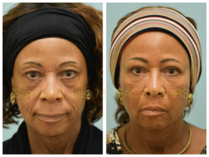 Blepharoplasty fat grafting fillers MesoBotox lip lift Before and After Photo by Dr. Lam in Plano TX
