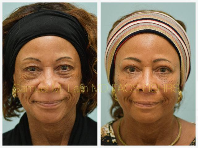 Blepharoplasty, fat grafting, fillers, MesoBotox, lip lift Before and After Photo by Dr. Lam in Plano, TX