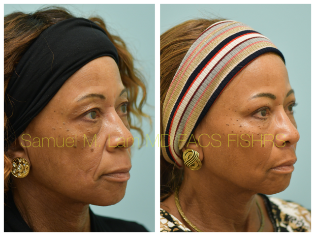 Blepharoplasty, fat grafting, fillers, MesoBotox, lip lift Before and After Photo by Dr. Lam in Plano, TX