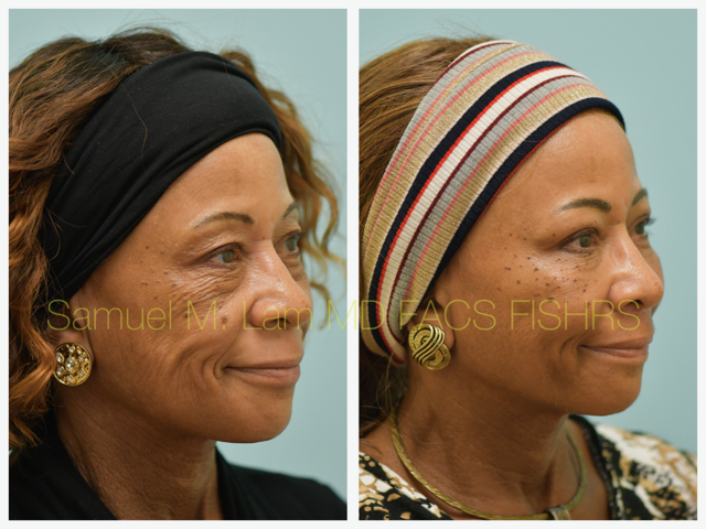 Blepharoplasty, fat grafting, fillers, MesoBotox, lip lift Before and After Photo by Dr. Lam in Plano, TX