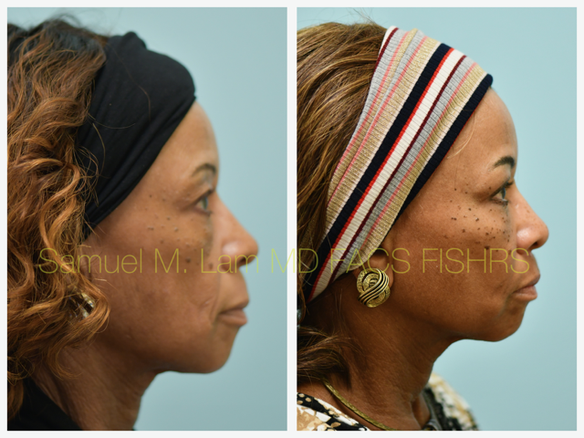 Blepharoplasty, fat grafting, fillers, MesoBotox, lip lift Before and After Photo by Dr. Lam in Plano, TX