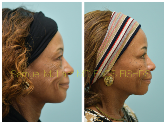 Blepharoplasty, fat grafting, fillers, MesoBotox, lip lift Before and After Photo by Dr. Lam in Plano, TX