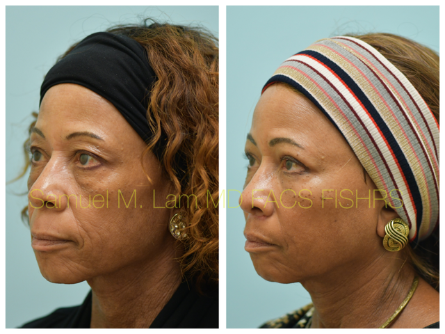Blepharoplasty, fat grafting, fillers, MesoBotox, lip lift Before and After Photo by Dr. Lam in Plano, TX