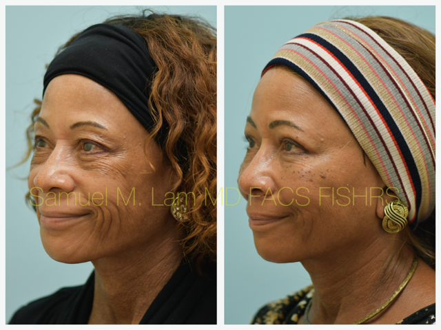 Blepharoplasty, fat grafting, fillers, MesoBotox, lip lift Before and After Photo by Dr. Lam in Plano, TX