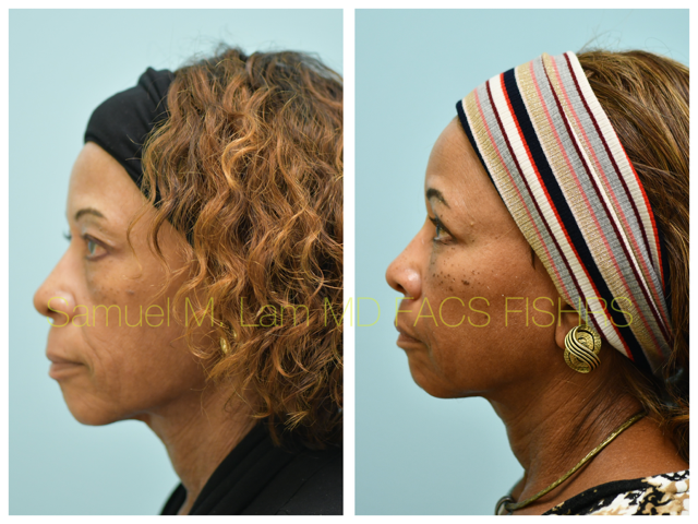 Blepharoplasty, fat grafting, fillers, MesoBotox, lip lift Before and After Photo by Dr. Lam in Plano, TX