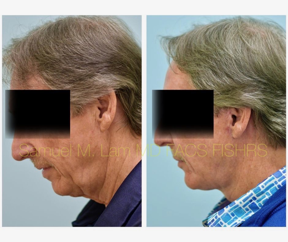 Facelift and Chin Implant Before and After Photo by Dr. Lam in Plano, TX