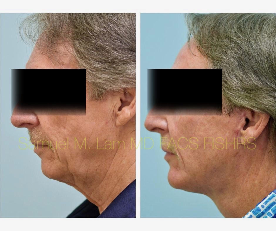 Facelift and Chin Implant Before and After Photo by Dr. Lam in Plano, TX