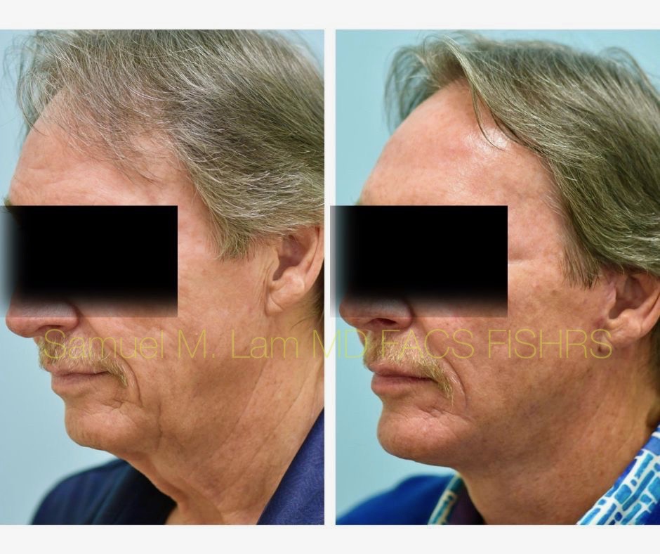 Facelift and Chin Implant Before and After Photo by Dr. Lam in Plano, TX