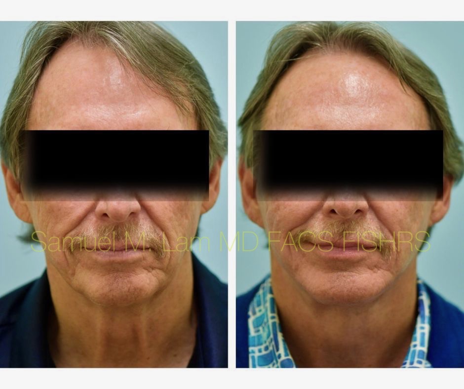 Facelift and Chin Implant Before and After Photo by Dr. Lam in Plano, TX