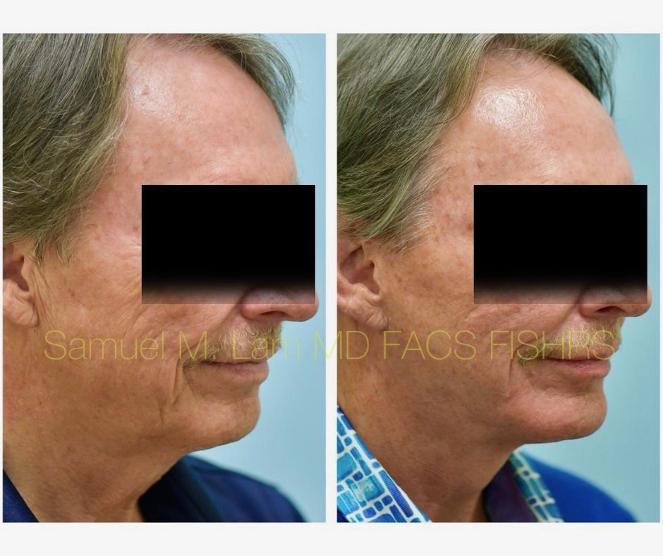 Facelift and Chin Implant Before and After Photo by Dr. Lam in Plano, TX