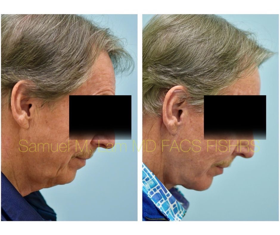 Facelift and Chin Implant Before and After Photo by Dr. Lam in Plano, TX