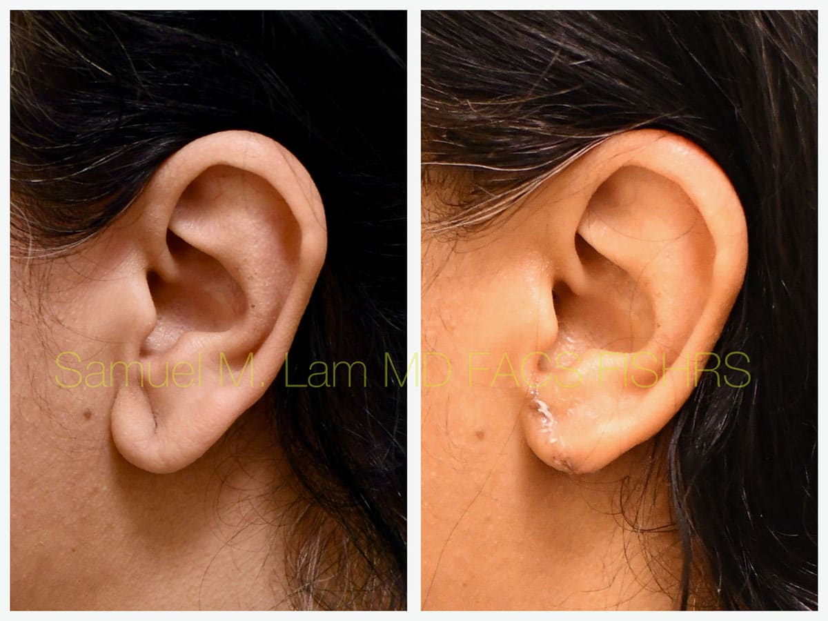 Torn Earlobe Repair Before and After Photo by Dr. Lam in Plano, TX