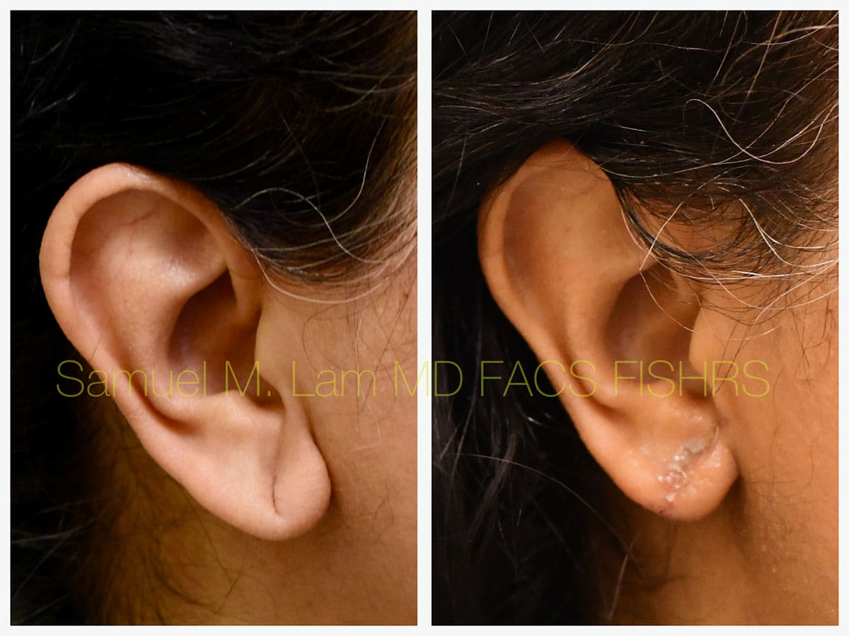 Torn Earlobe Repair Before and After Photo by Dr. Lam in Plano, TX
