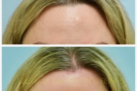 Before After Photos Osteoma Removall