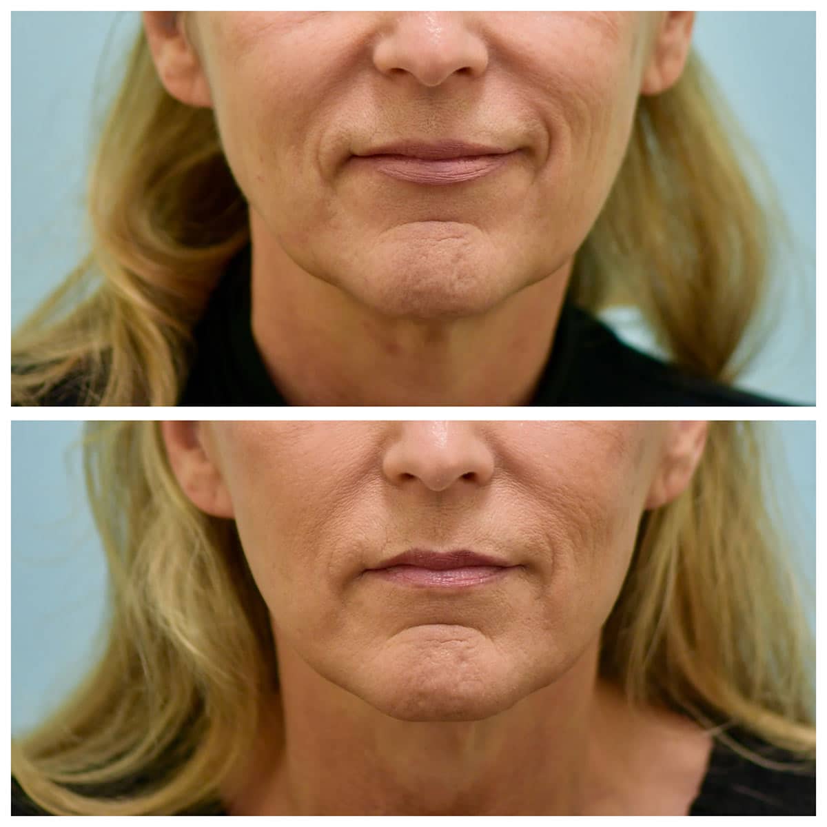 Face:Neck Lift Before and After Photo by Dr. Lam in Plano, TX