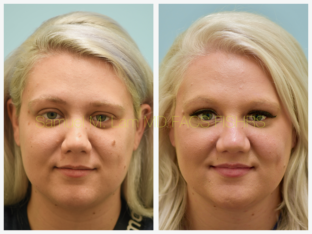 Mole Removal Before and After Photo by Dr. Lam in Plano, TX