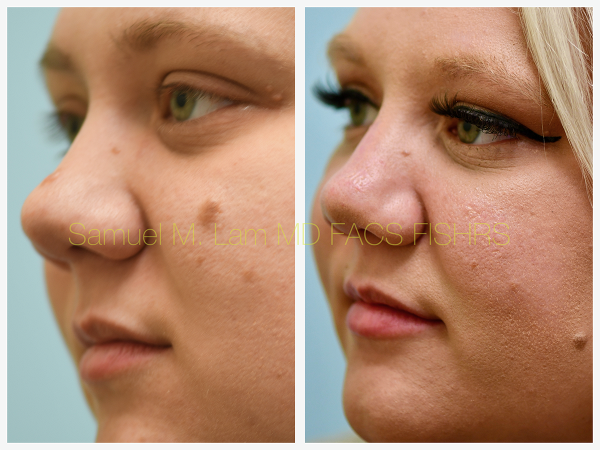 Mole Removal Before and After Photo by Dr. Lam in Plano, TX