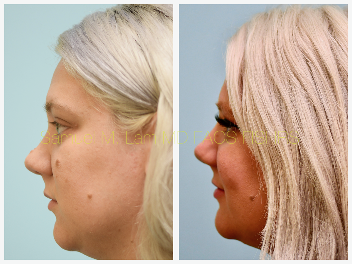 Mole Removal Before and After Photo by Dr. Lam in Plano, TX