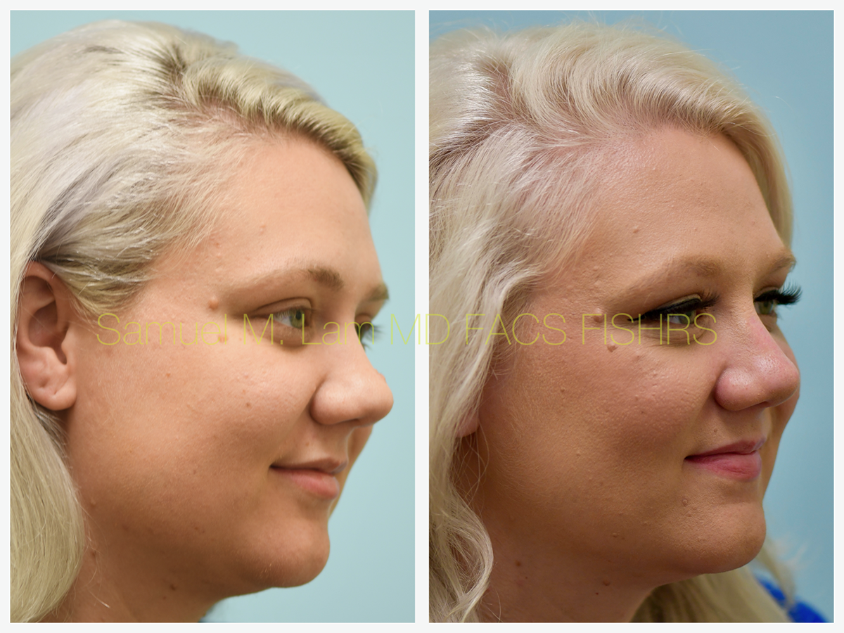 Mole Removal Before and After Photo by Dr. Lam in Plano, TX
